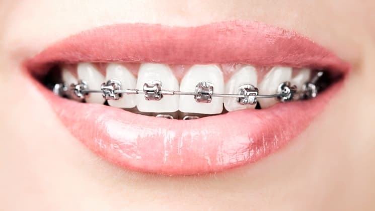 Boca con brackets autoligables