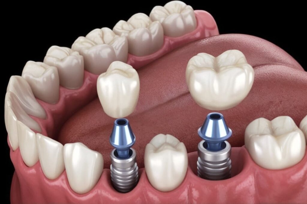 Una foto de una dentadura con implantes